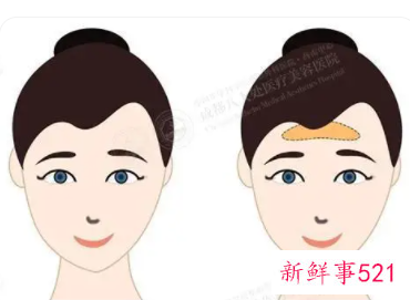 脸部凹陷怎么恢复饱满