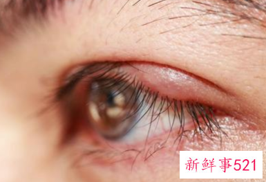 去除眼袋有几种方法