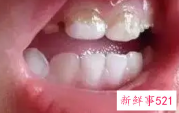一岁宝宝怎么清洁牙齿