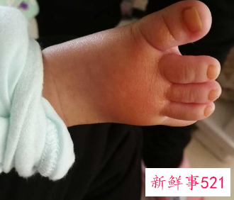 宝宝脚背红肿怎么缓解