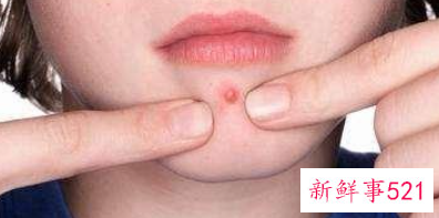 下巴白头粉刺的原因及预防方法