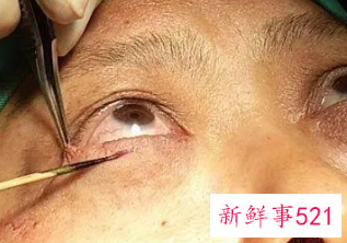 去除眼袋有几种方法