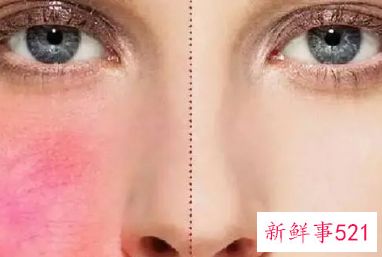 怎样改善脸上红血丝小妙招