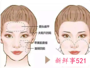 脸部凹陷怎么恢复饱满