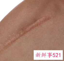 伤疤没好撕掉会有什么影响