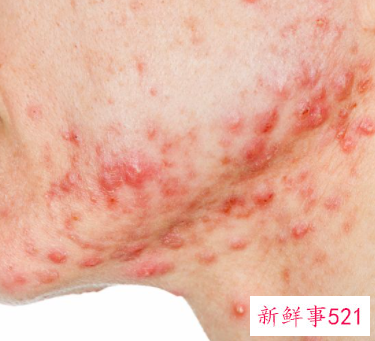 痤疮会不会长一辈子