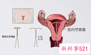 取环疼吗大概要几分钟