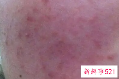 用完洗面奶后脸通红怎么办