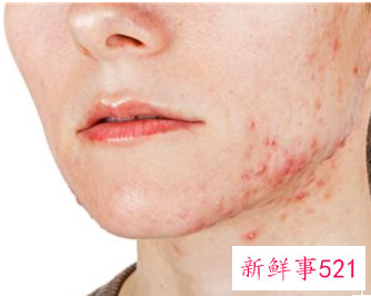 痤疮会不会长一辈子