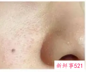 闭口粉刺和开口粉刺的区别