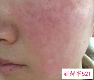 为什么脸上又红又痒反复发作