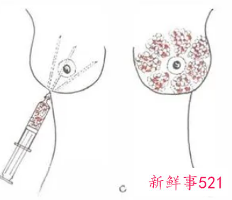 丰体针丰胸有什么副作用