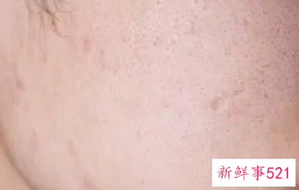 用完洗面奶后脸通红怎么办