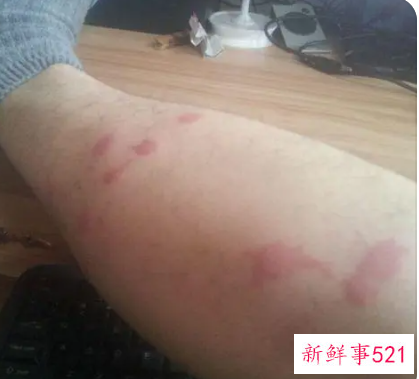 梦见自己腿上长了一个大包