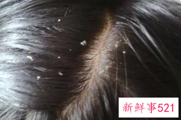 头上长很多头皮屑怎么办