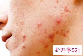 痤疮怎么改善