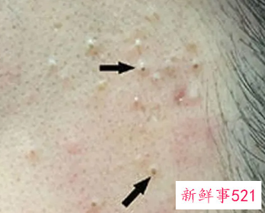 闭口粉刺和开口粉刺的区别