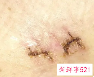 伤疤没好撕掉会有什么影响