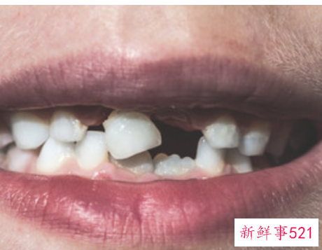 已婚女人梦见掉牙