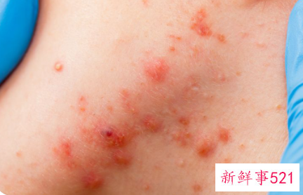 为什么脸上又红又痒反复发作