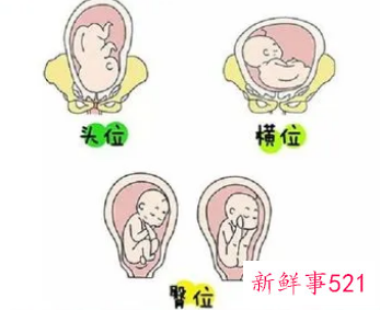 胎儿24周臀位孕妇少坐