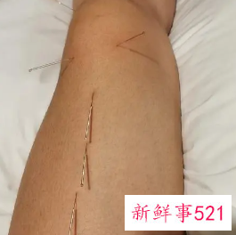 针灸为什么不能下午扎