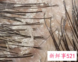 头上长很多头皮屑怎么办