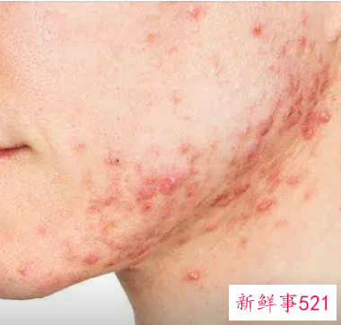 痤疮会不会长一辈子