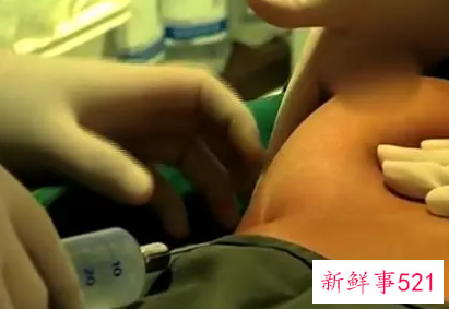 丰体针丰胸有什么副作用