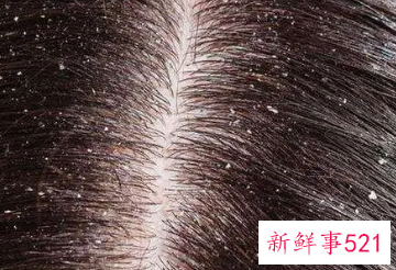 头上长很多头皮屑怎么办