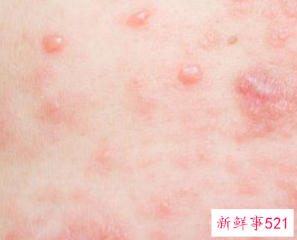 hpv感染能治好吗