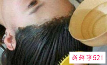 头上长很多头皮屑怎么办