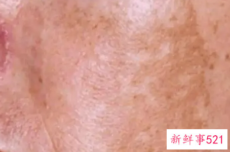 最近脸上长斑怎么办