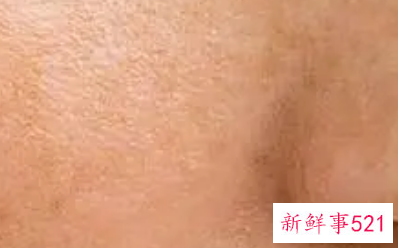 黑色素溶解了自己能排出去吗