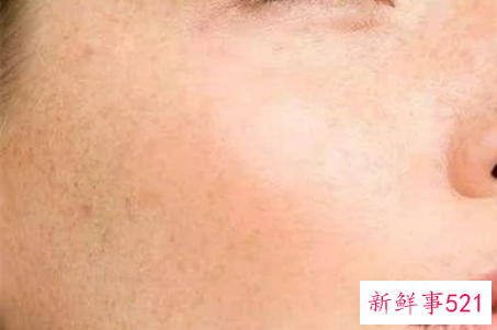最近脸上长斑怎么办