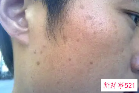 最近脸上长斑怎么办