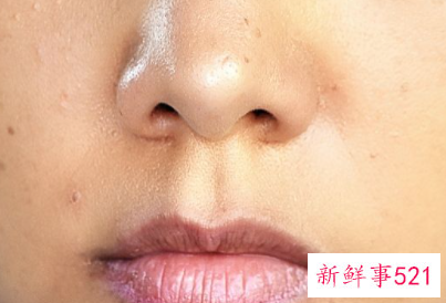 什么药可以去黑色素