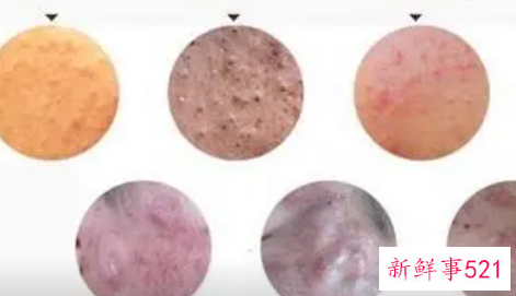 经期前后痘痘该如何护理