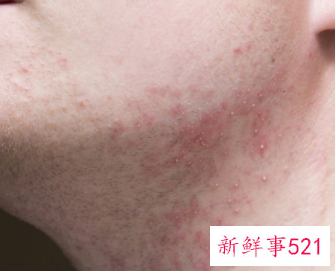 孩子对花粉过敏可以脱敏吗