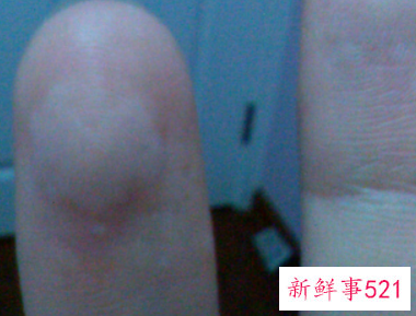 手指头有白点点