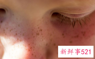 如何彻底清理脸部毛孔垃圾