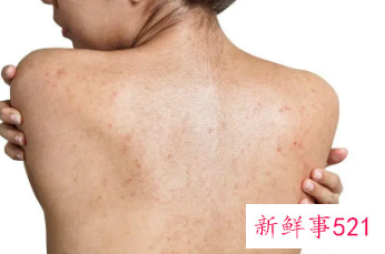 后背皮肤病种类