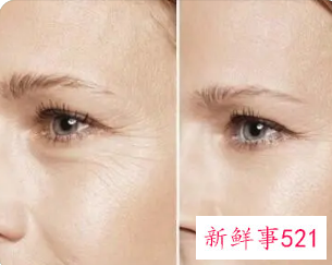 皱纹和细纹哪个更严重