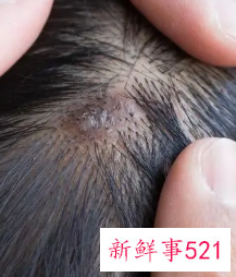 头皮有螨虫怎么办