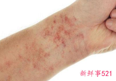 紫癜会免疫球蛋白A和M高吗