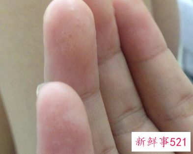 手指头有白点点