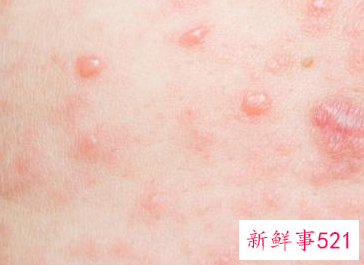 热水洗澡皮肤痒起红点