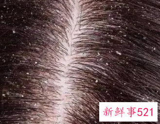 洗完头头皮屑还特别多怎么办