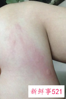 天气冷皮肤瘙痒