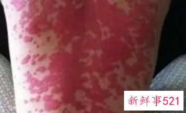 如何判断有没有性疾病